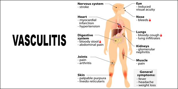 Mari mengenal Kondisi Autoimun Vaskulitis